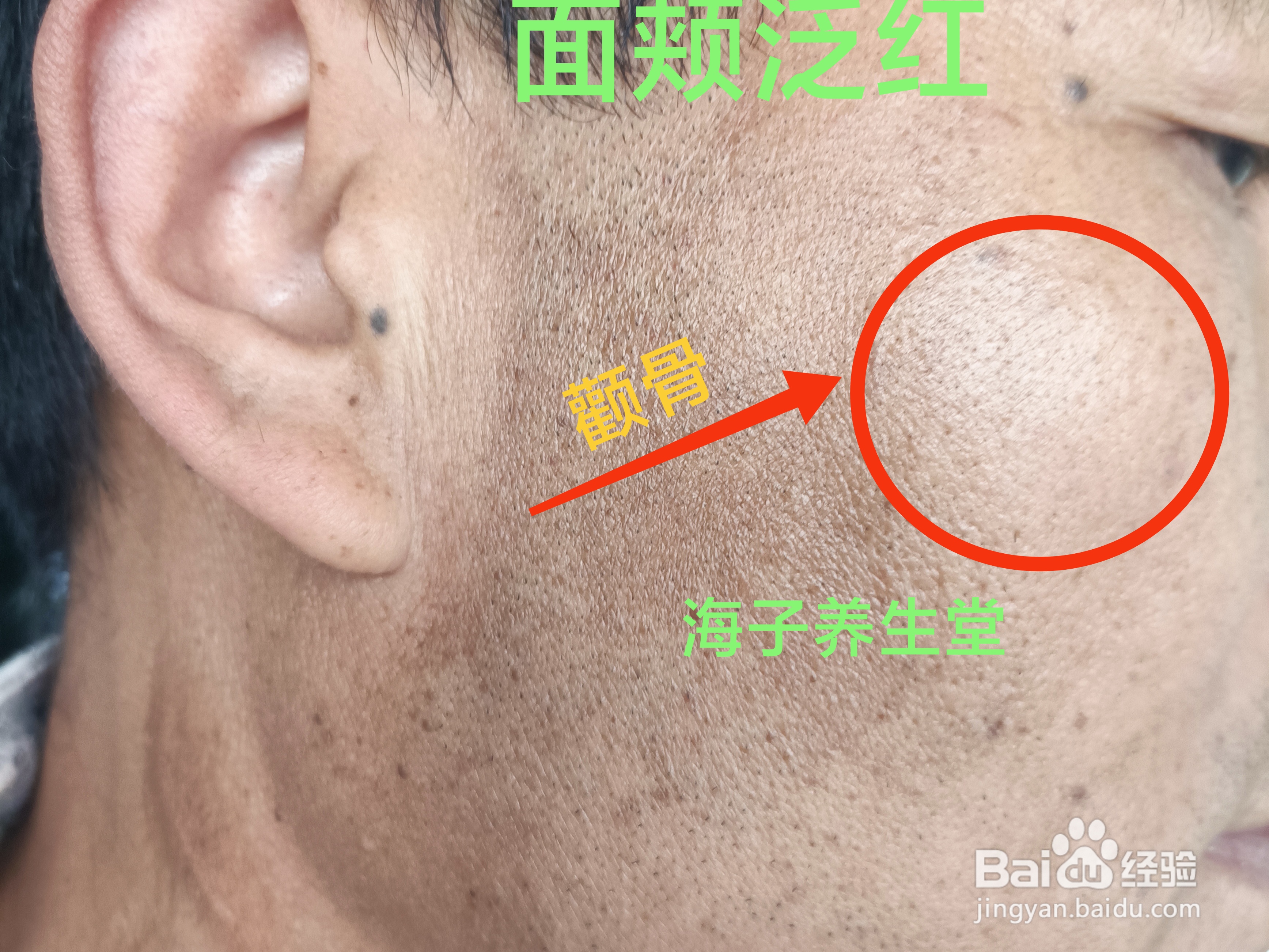 面颊泛红怎么调理
