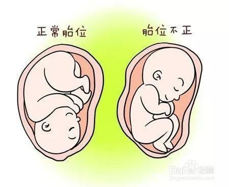 孕后期如何预防胎位不正