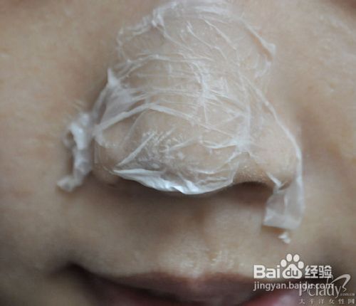 黑头的成因及去黑头的最好方法