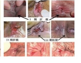 肛裂如何自愈