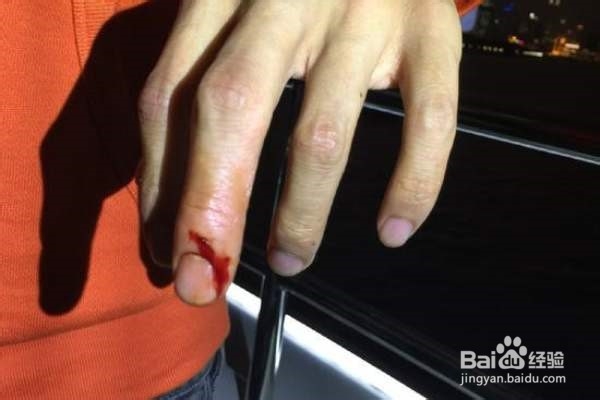 受伤时候如何快速止血