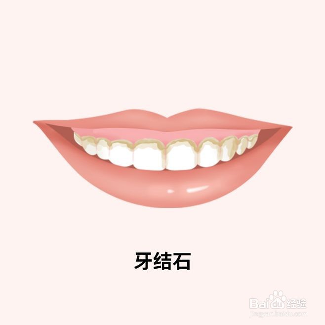 什么是牙结石？有什么危害？