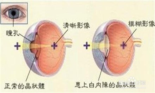 白内障手术前的准备