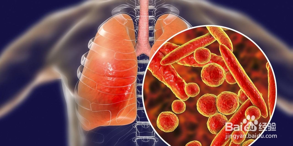 从武汉回来如何预防武汉肺炎