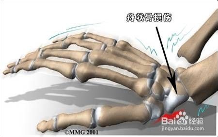 腕部骨折中的隐形杀手 百度经验