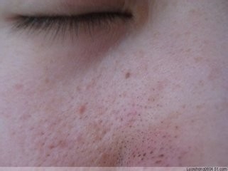 怎么去黑头？我有办法！！