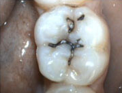 日常健牙护齿注意事项