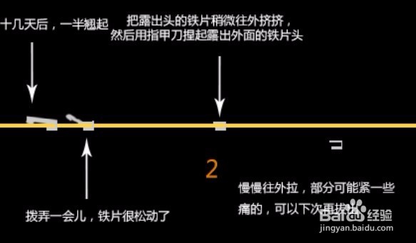 包皮环切术术后取缝合钉子经验(详细版)
