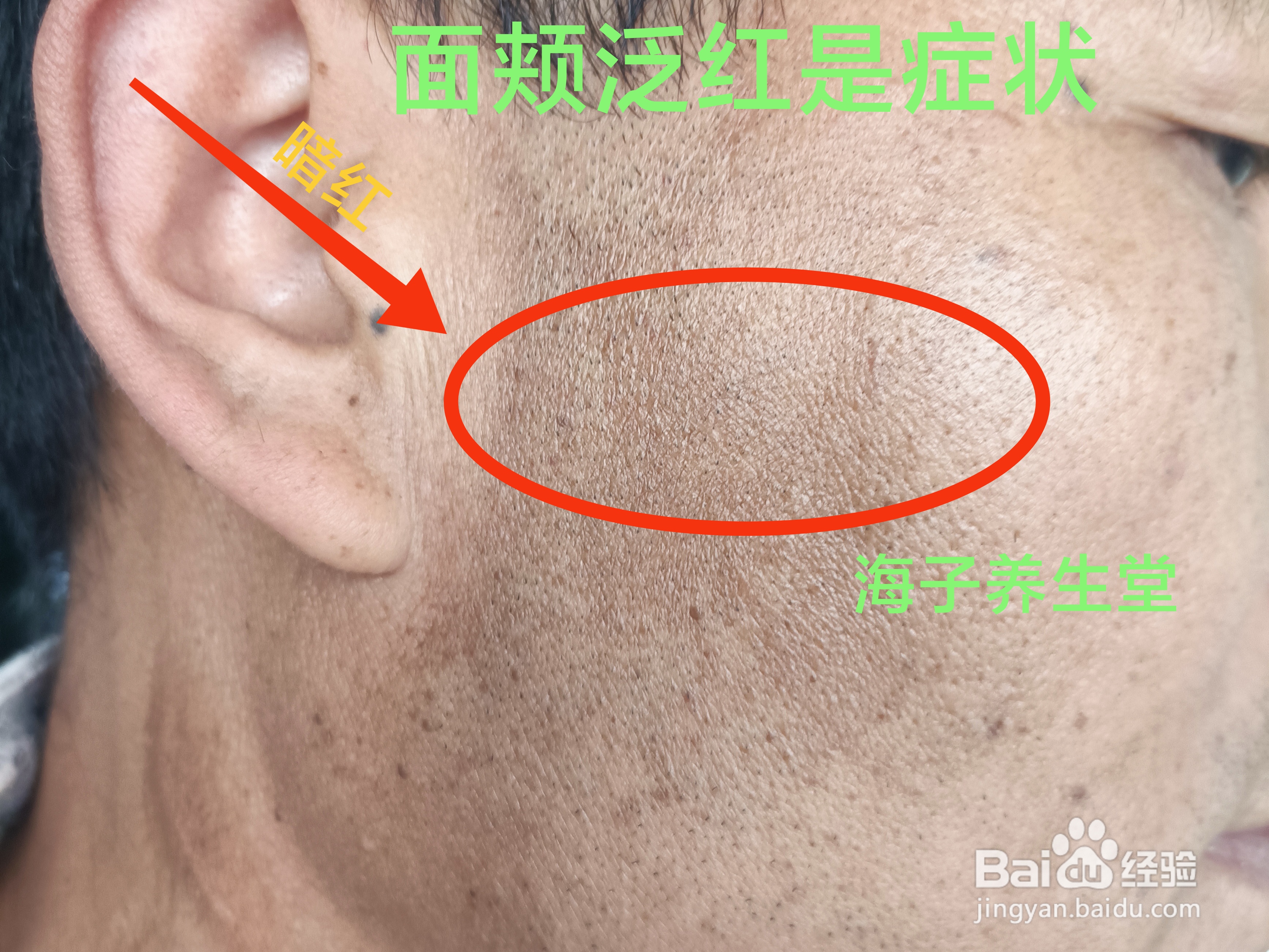 面颊泛红怎么调理