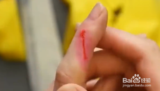 怎么快速处理小伤口