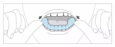 南宁隐形矫治器正确的摘戴方法