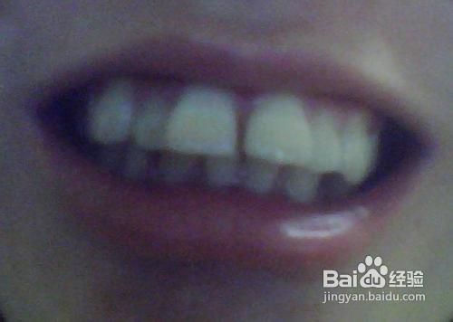 龅牙的价格是多少?