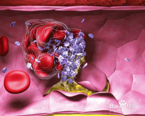 血栓,是怎么形成的?