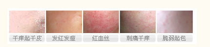 皮肤过敏怎么办，可采取的应变措施