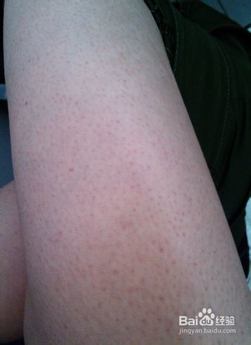 鸡皮肤能治好吗【精华篇】