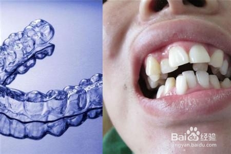 为什么牙齿需要矫正?