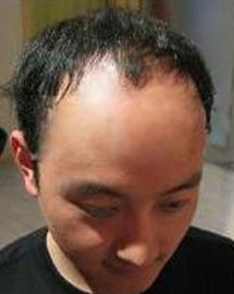 M字头地中海都有救 手指按摩穴道有助生发 百度经验