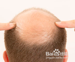 经常脱发怎么办