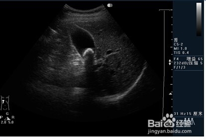 胆道系统几种常见疾病的影像图片。