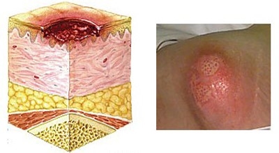 压疮的治疗方法