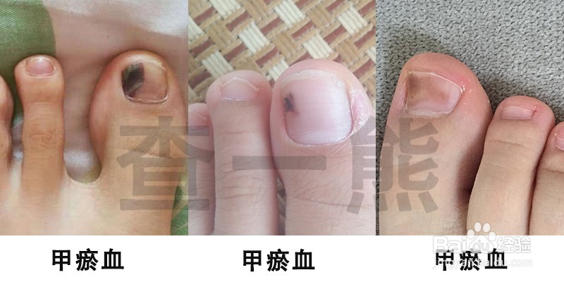 孙叔公灰指甲治疗手册