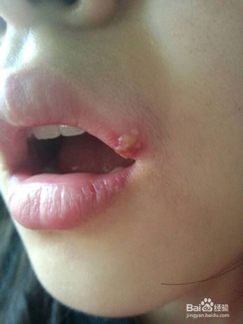 嘴唇疱症 嘴唇痒起密集小水泡 怎么办 百度经验