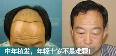 植发手术常见问题介绍