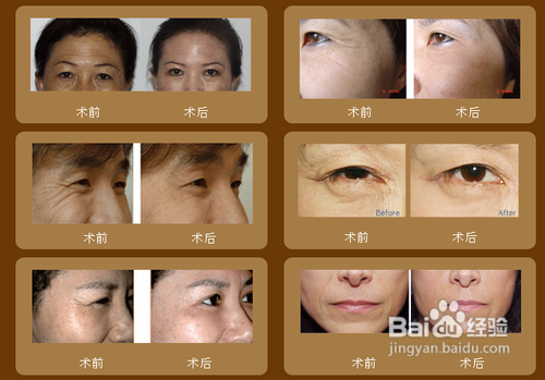 除皱用什么方法最好