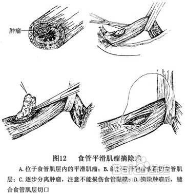 食管平滑肌瘤可诱发哪些症状