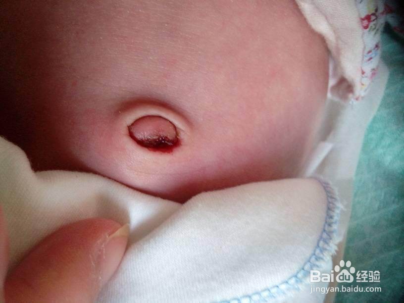 新生宝宝的肚脐应该如何护理？