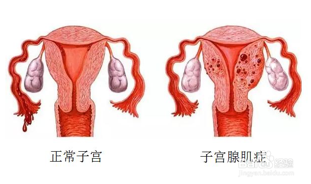 子宫腺肌症最忌讳什么这四点一定要注意