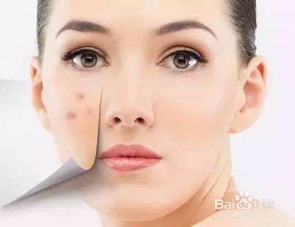 痘印多久能消除？祛痘印的方法有哪些？