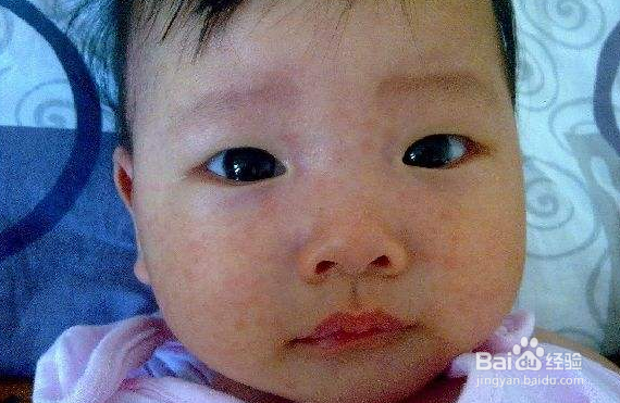 给孩子喂养辅食后孩子出现过敏怎么办？