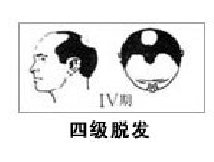 男性流花植发有哪些优点和特点?