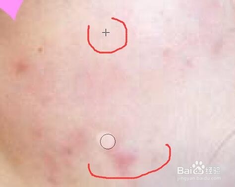 PS怎么去掉照片脸上的痘印斑点