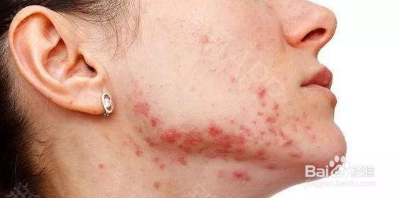 长痘痘的原因及调理方法