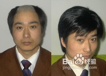 脱发的具体原因