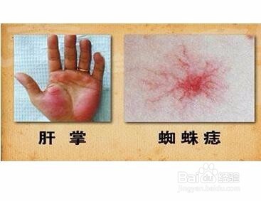 肝硬化的早期症状