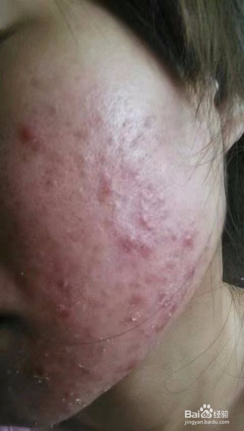 异维A酸，针清治痘痘经历