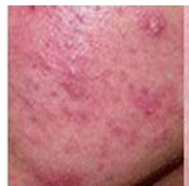 患上皮炎怎么办