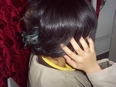 偏头痛的针灸治疗