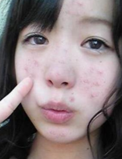 怎么祛痘痘最有效的方法