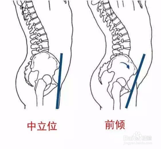 如何矫正骨盆前倾-百度经验