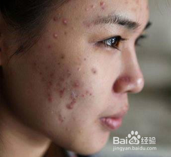 怎么判断脸上有螨虫,脸上有螨虫的症状