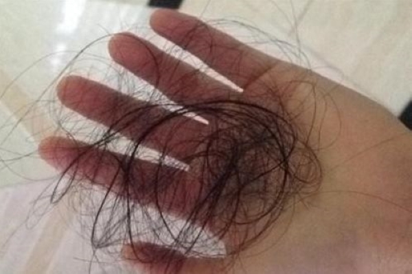 每晚洗头时掉几十根头发。正常吗