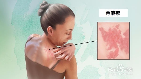 食物过敏与荨麻疹 自我检测指南