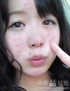 有痘痘要注意啦!!