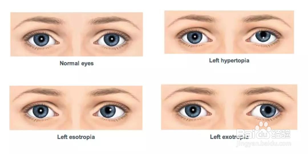 浅谈斜视的视觉训练思路