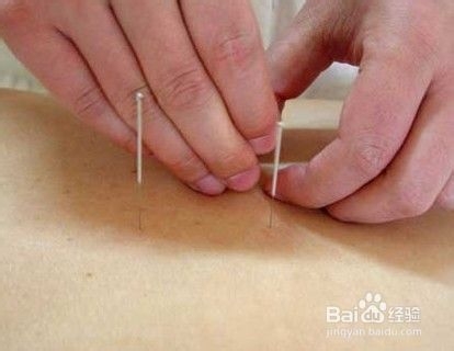 针灸减肥须知哪些