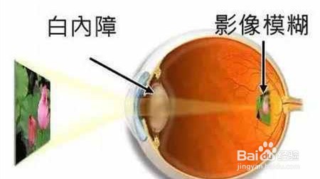 高度近视的危害